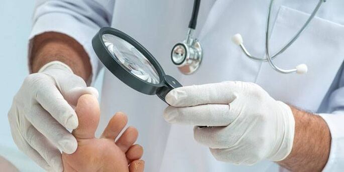 lékař vyšetří nohu s bradavicí na chodidle
