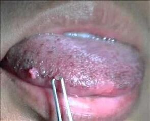 lidský papilomavirus na jazyku