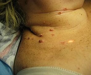 lidský papilomavirus na krku