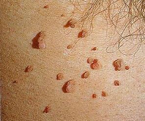 lidský papilomavirus na kůži