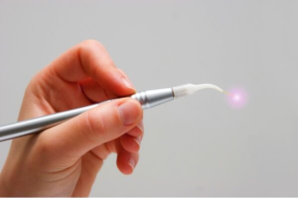 laser pro odstranění papilomů