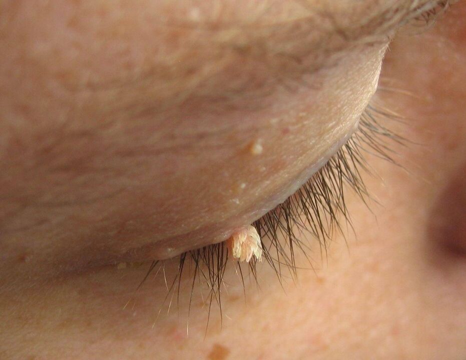 papilomy na očním víčku