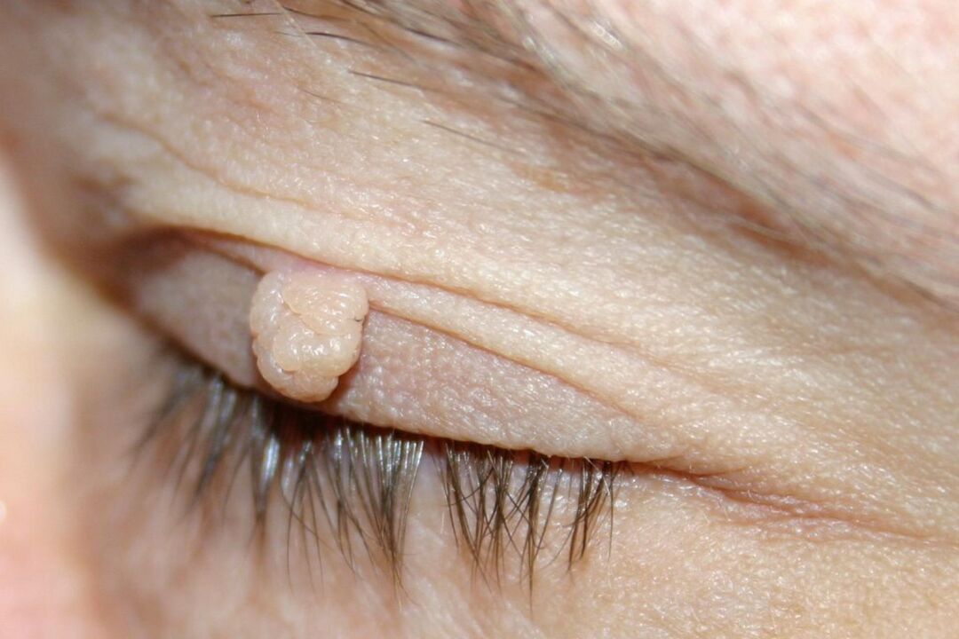 příznaky papilomu na očním víčku