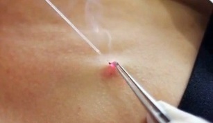 odstranění papilomů na těle laserem